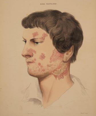 acne.jpg