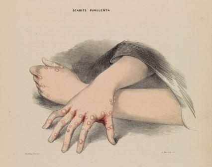 scabies.jpg