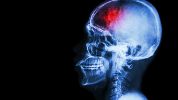 Neurology and Stroke