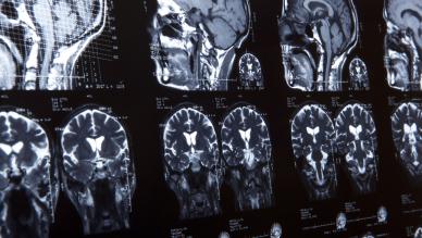 human brain/MRI/scan