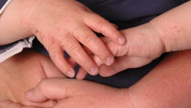 Eczema on hands