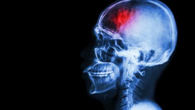 Neurology and Stroke