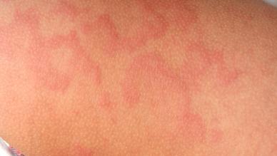 Acute Dermatology