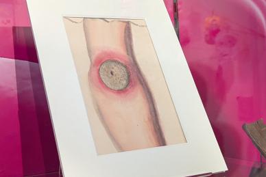 A coloured illustration on display in a museum case. The illustration is of an arm, with a large infected-looking blister part way down.