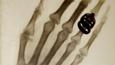 James Gifford x ray
