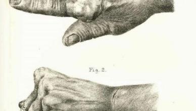 Charcot