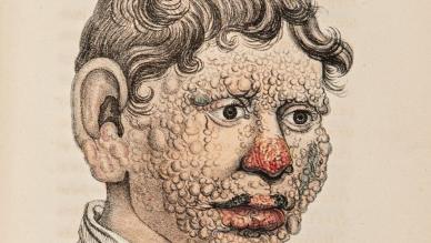 Thomas Shapter A few observations on the leprosy of the Middle Ages, 1835